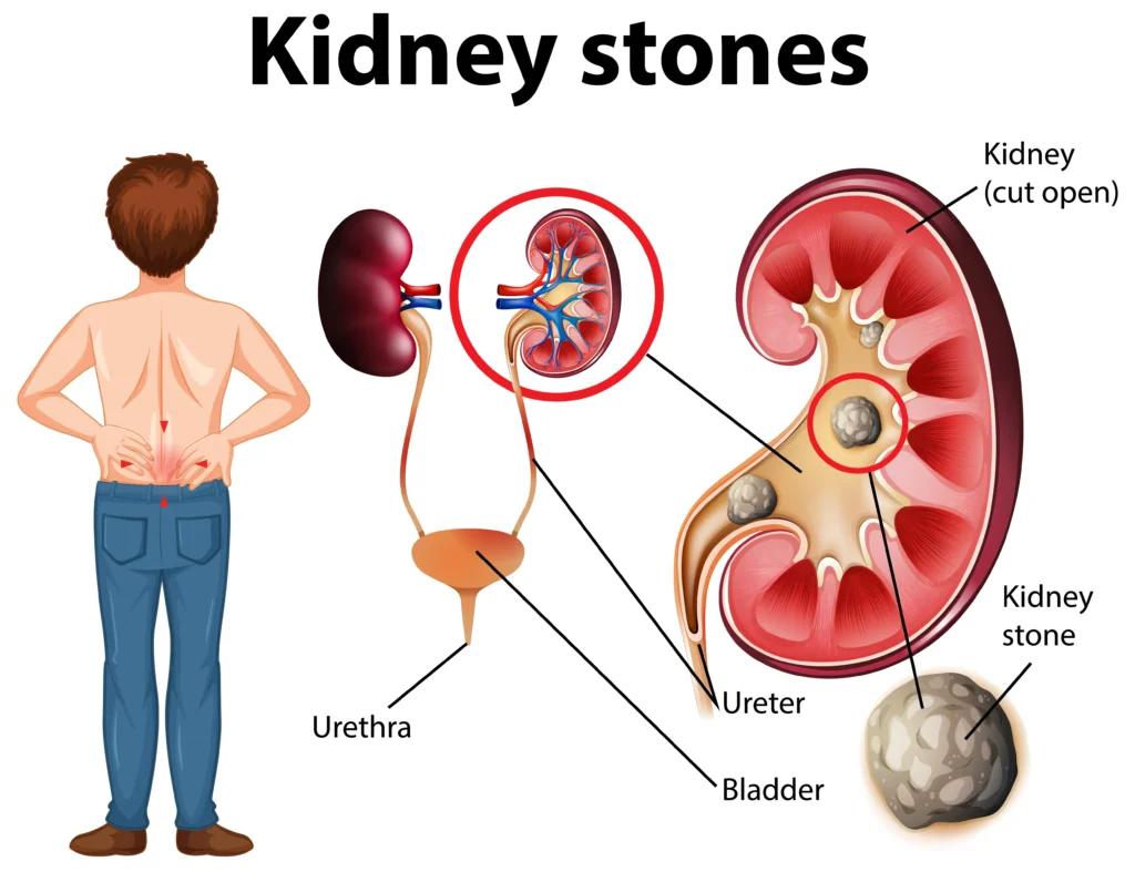 Kidney Stone Made Of