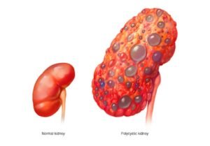 Polycystic Kidney Disease