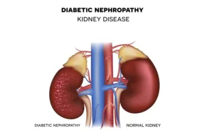 Diabetic Kidney Disease