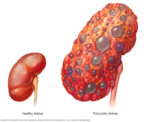 End-Stage Renal Disease