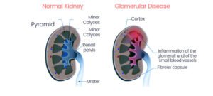 Glomerular Diseases