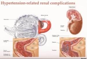 Hypertension and Kidney Health