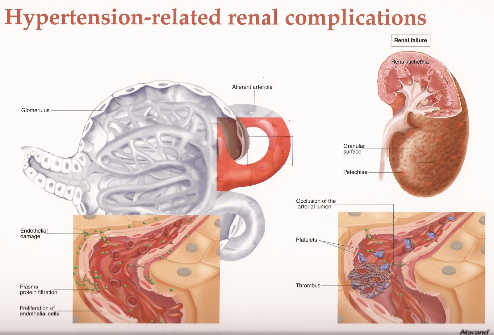 Hypertension and Kidney Health