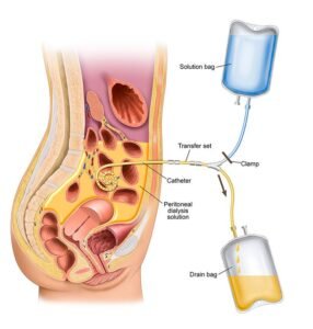 Peritoneal Dialysis
