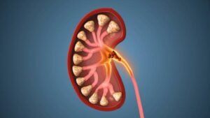 Slow Chronic Kidney Disease