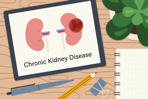 Stage 3 CKD