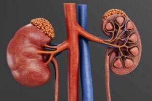 Stage 3 CKD Kidney Cancer