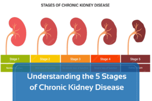 Understanding the 5 Stages of Chronic Kidney Disease