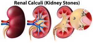 What Is Your Kidney Stone Made Of